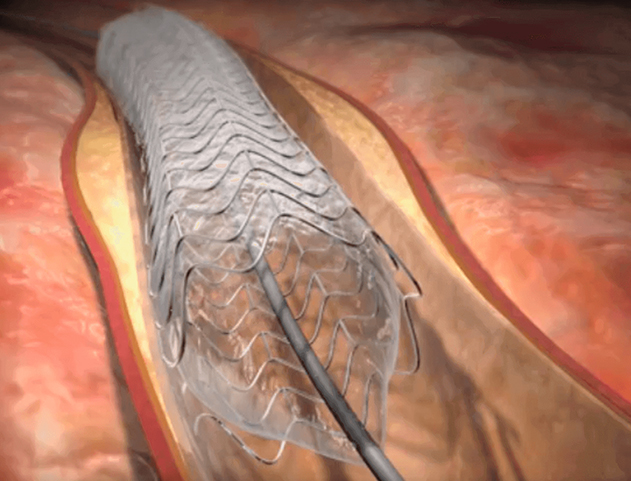 NEUROCIRUGÍA ENDOVASCULAR Y CARDIOINTERVENCIONNIMO